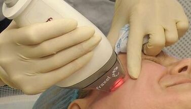 Jak przeprowadza się frakcyjne odmładzanie skóry