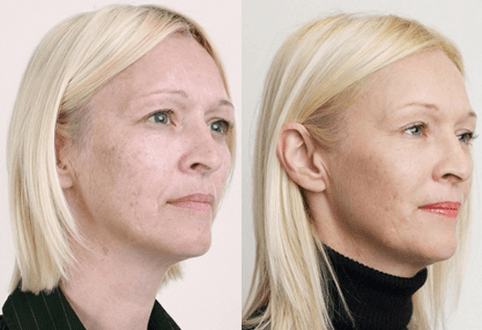 Średni peeling z kwasami owocowymi