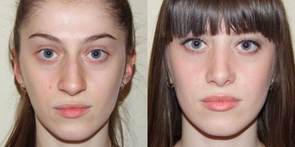 Dziewczyna przed i po odmładzaniu skóry twarzy plazmą