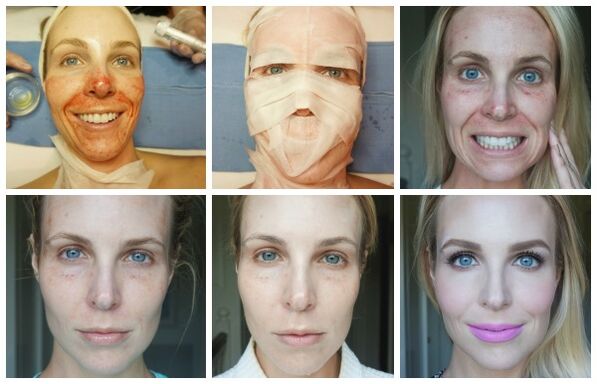 Etapy gojenia skóry twarzy po udanym liftingu plazmowym