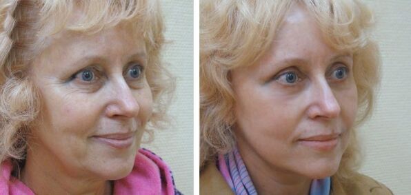 Kobieta przed i po plazmowym odmładzaniu skóry twarzy